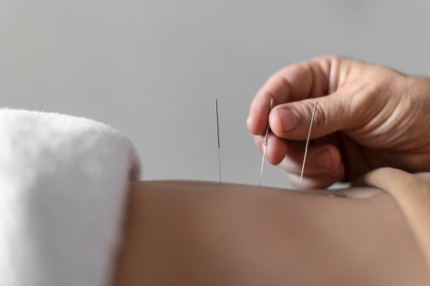 mão segurando agulha de acupuntura