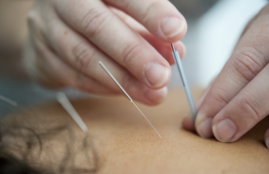 mãos aplicando acupuntura, uma técnica de medicina chinesa